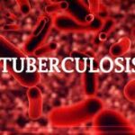 Kaduna State reports 32,297 cases of tuberculosis In 2023