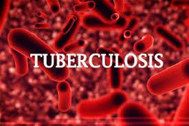 Kaduna State reports 32,297 cases of tuberculosis In 2023
